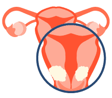 子宫颈癌