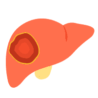 肝癌