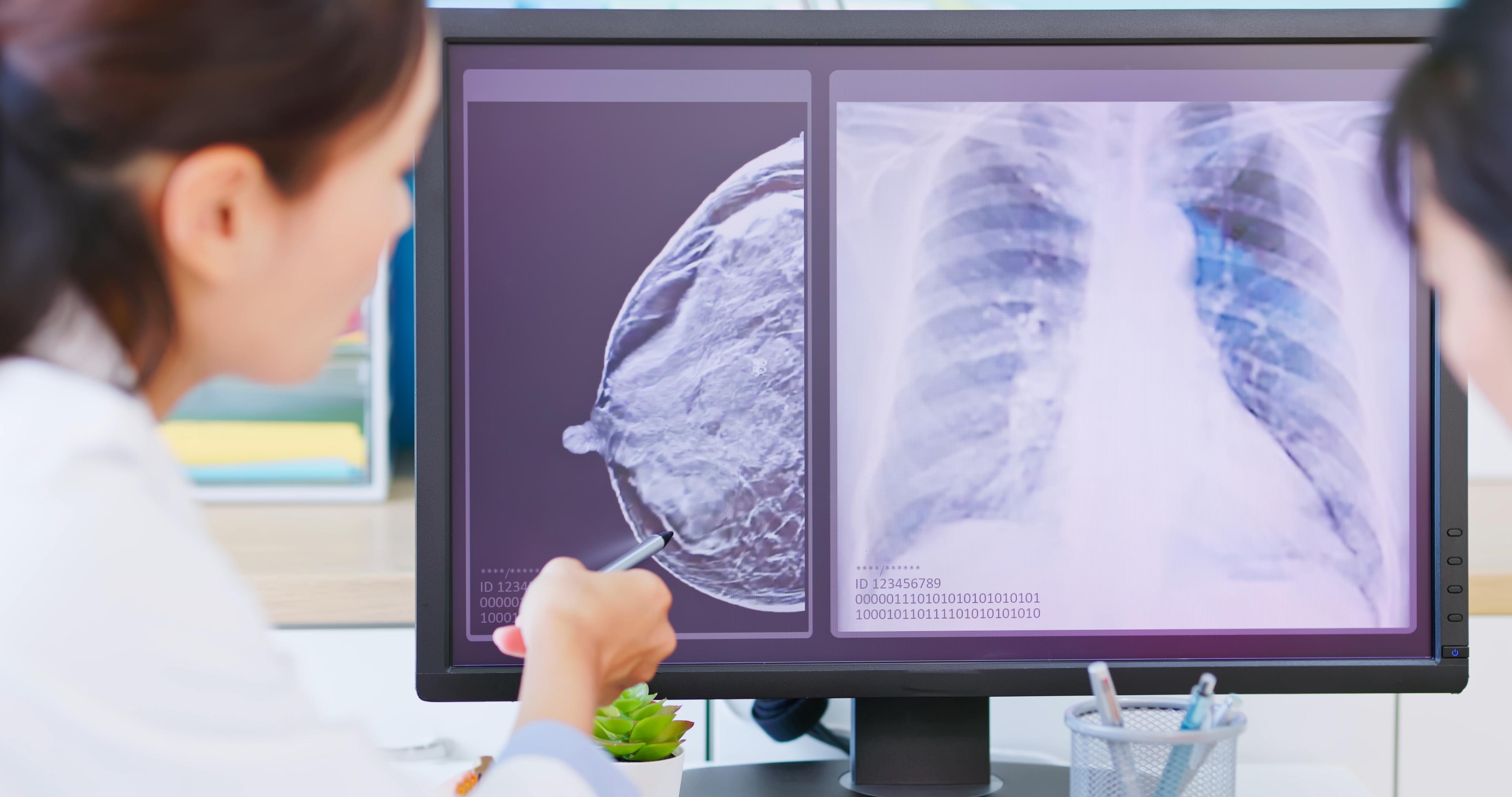 symptoms-diagnose-of-breast-cancer