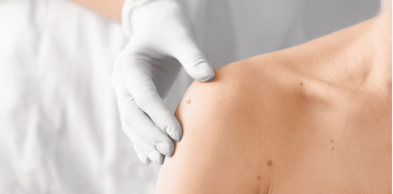 what-is-skin-cancer-mole-skin-spots