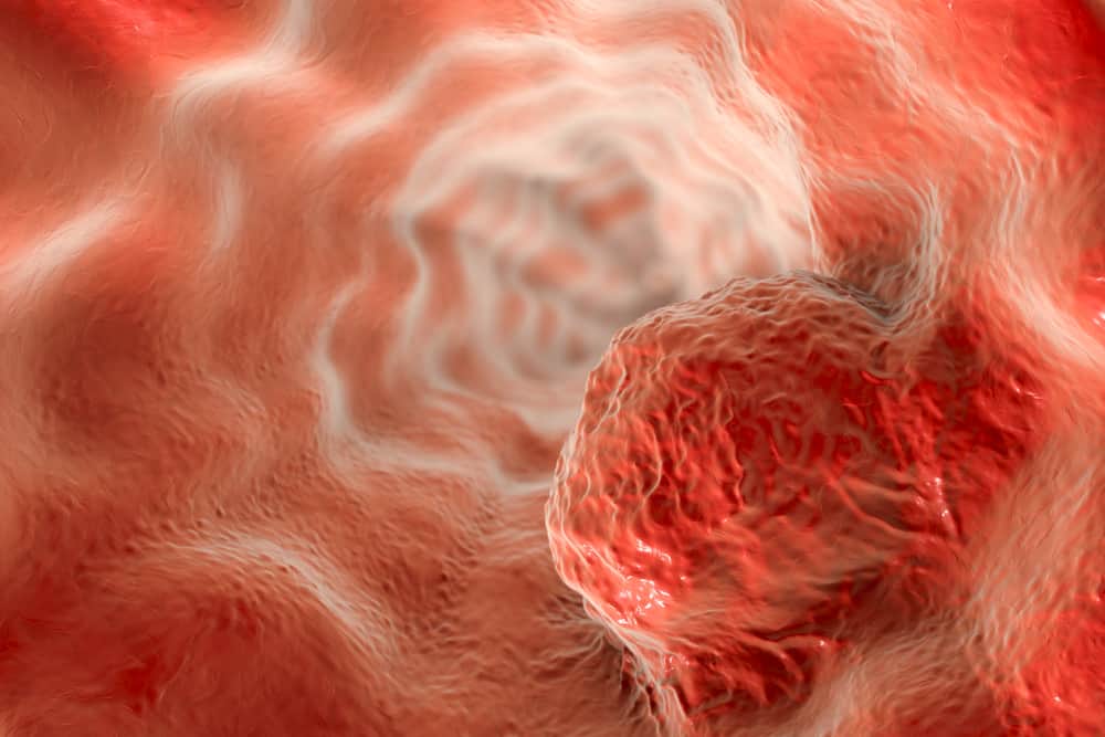 what-is-tumor-neoplasm