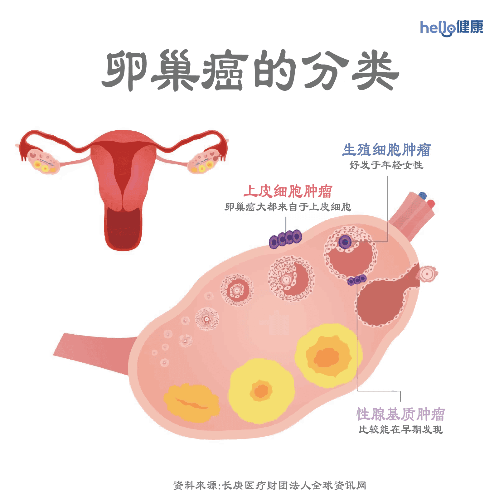 卵巢癌分类