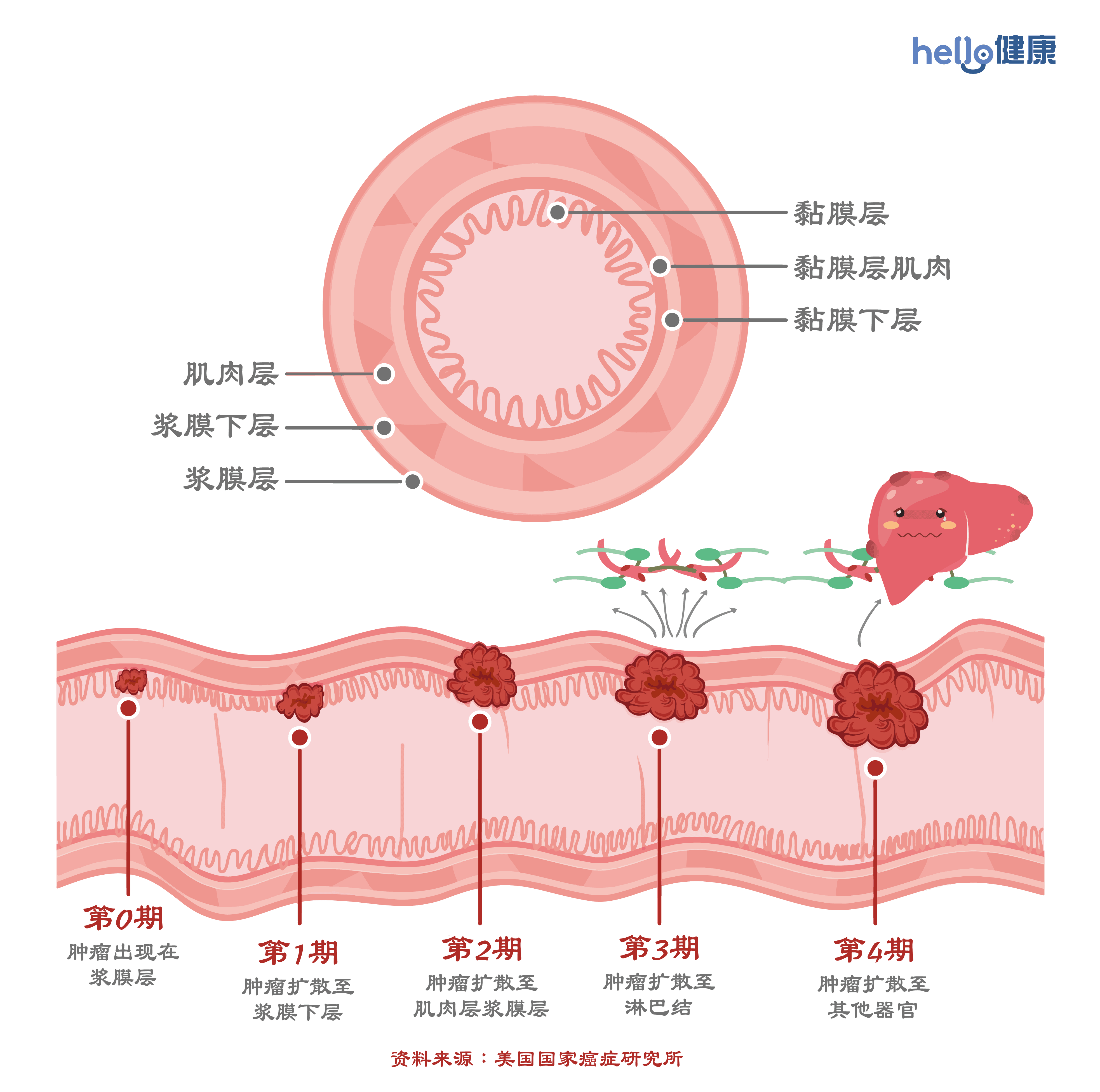 大肠癌-01-1-1