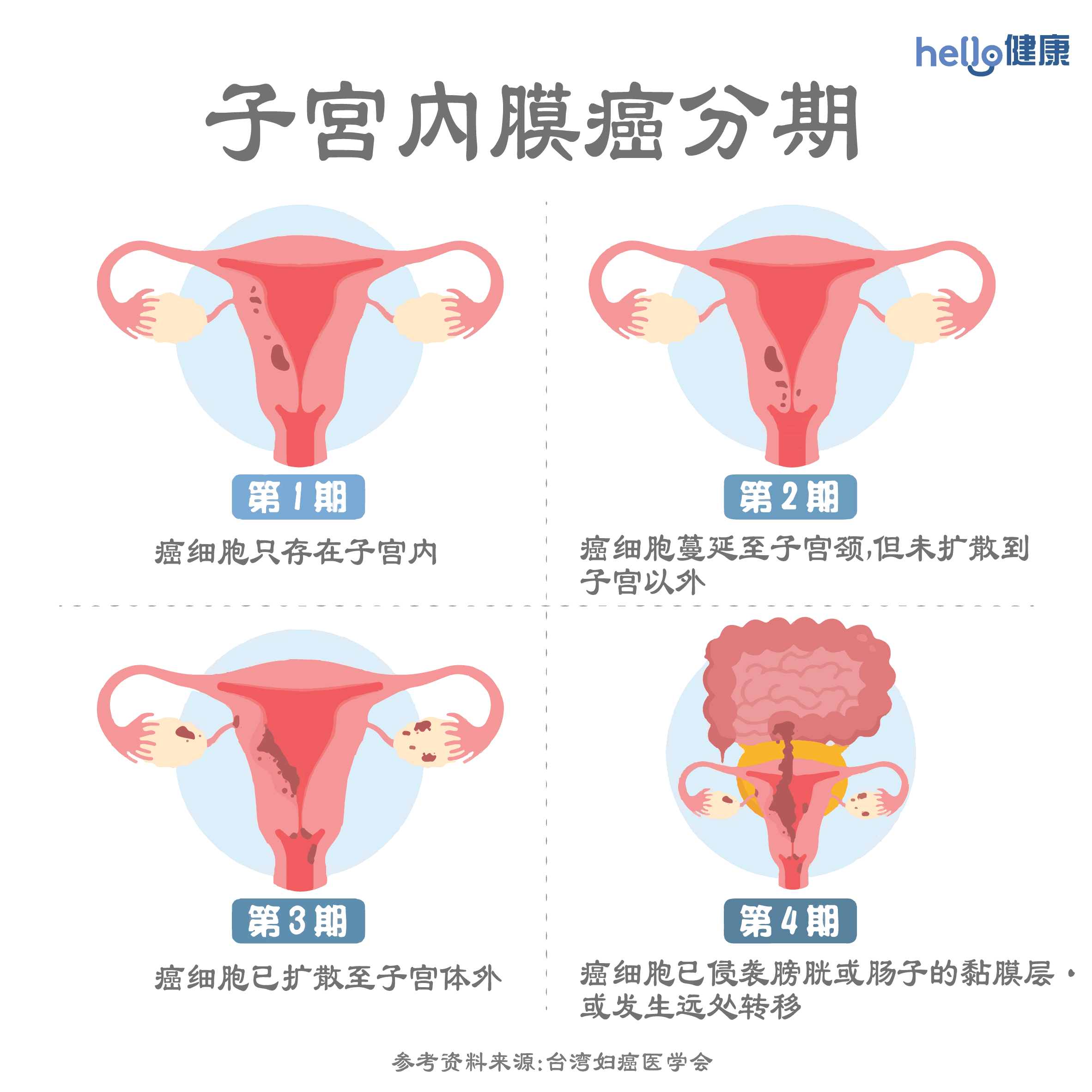 子宫内膜癌分期