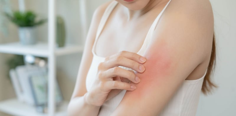 皮肤炎、湿疹、干癣？差别在哪一次弄懂！