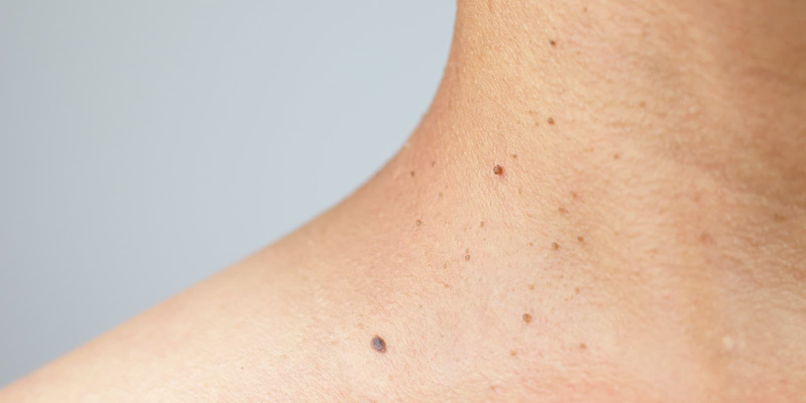 types-of-granulation-causes-and-treatment