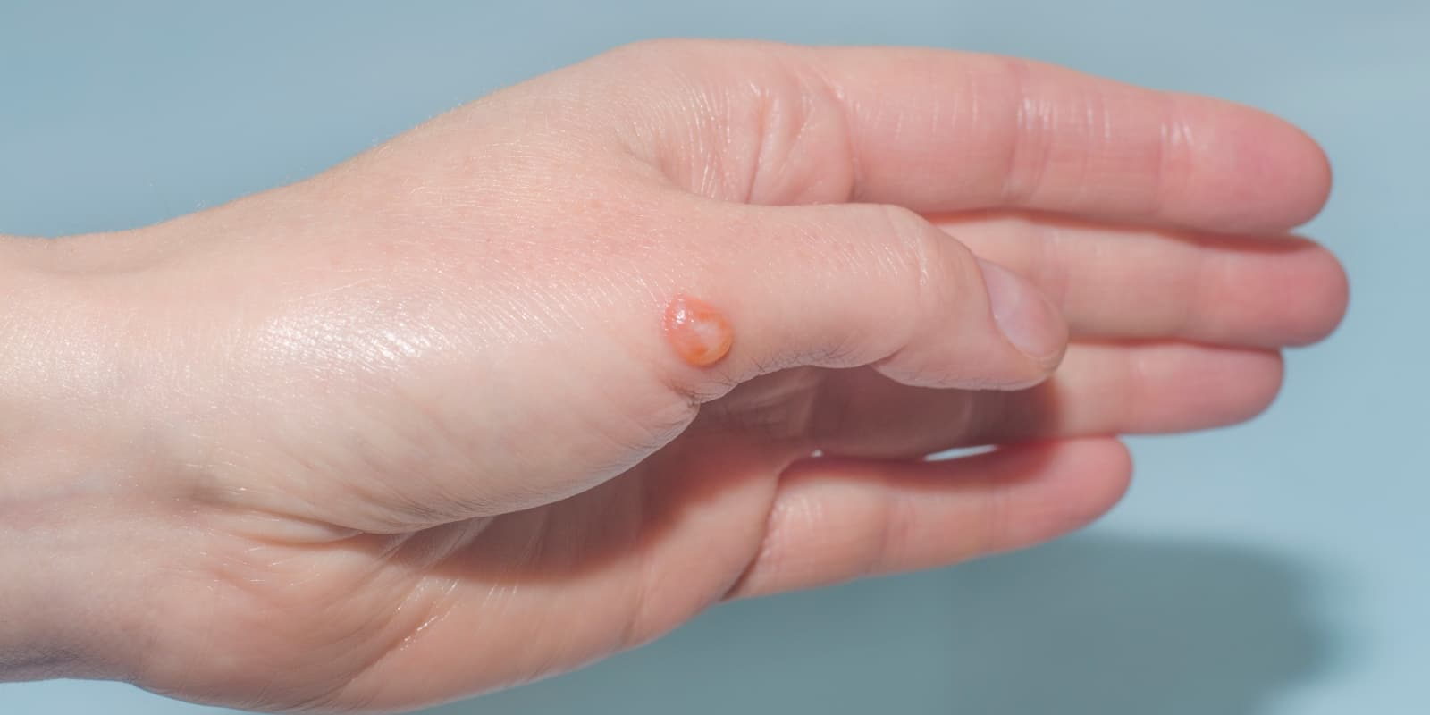 how-to-take-care-of-the-burn-causes-blisters
