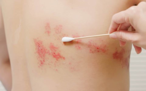 the-most-contagious-period-of-shingles