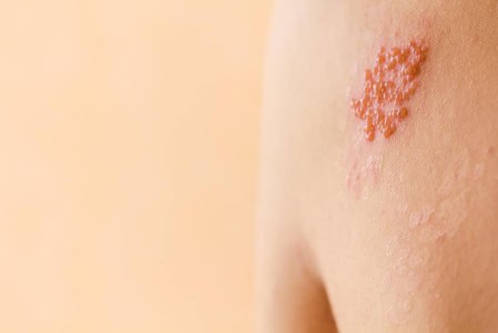 is-shingles-contagious-and-how-long-does-singles-take-to-heals