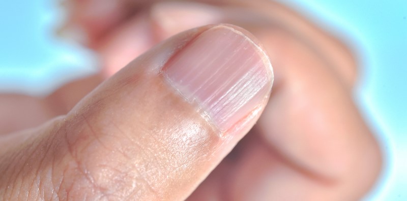 types-and-causes-explained-of-nail-ridges