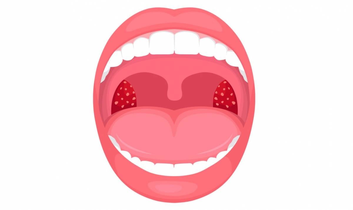 扁桃腺发炎：症状、原因、诊断、治疗