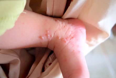 the-causes-and-treatment-of-dyshidrotic-eczema