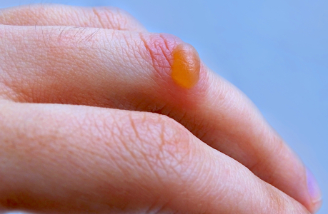when-is-it-appropriate-to-pop-a-blister