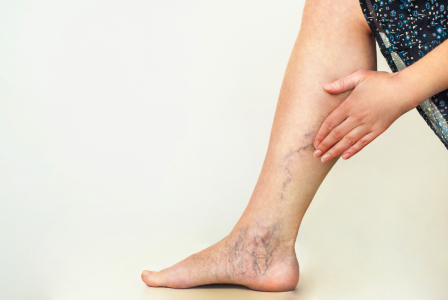 varicose-veins-symptoms-and-treatment