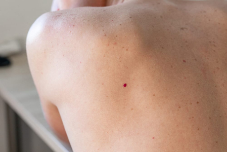 cherry-angiomas-could-be-a-warning-sign-of-liver-problems