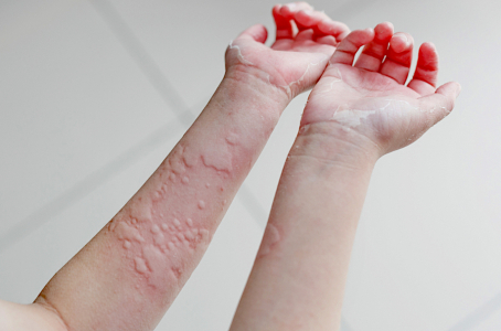 summary-of-urticaria