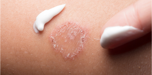 precautions-and-treatment-options-of-tinea-corporis