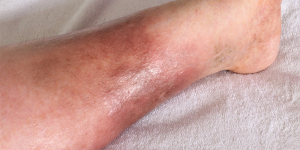 understanding-is-mrsa