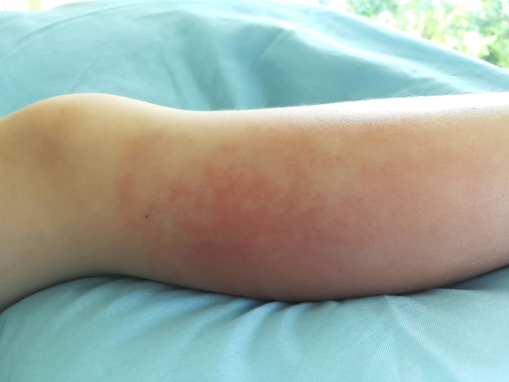 cellulitis-symptoms-you-shouldnt-ignore