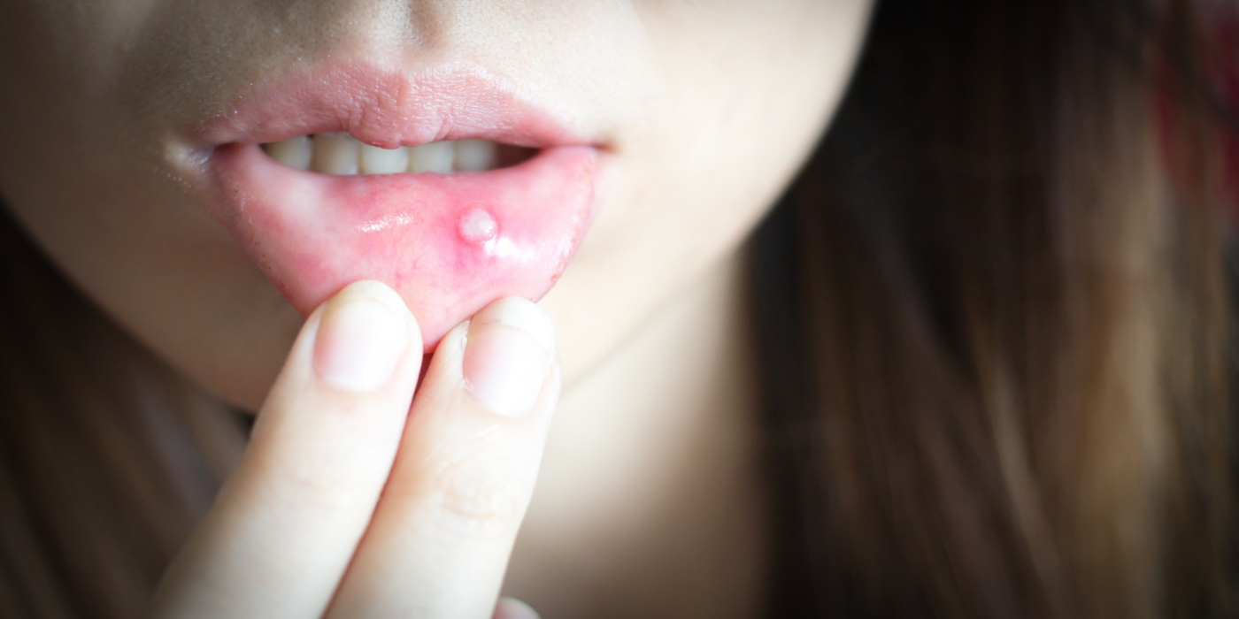 嘴巴破洞怎么办？口腔溃疡3招快速缓解
