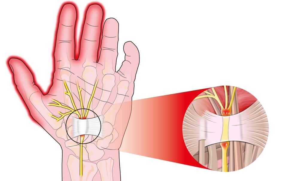 what-is-carpal-tunnel-syndrome-surgery