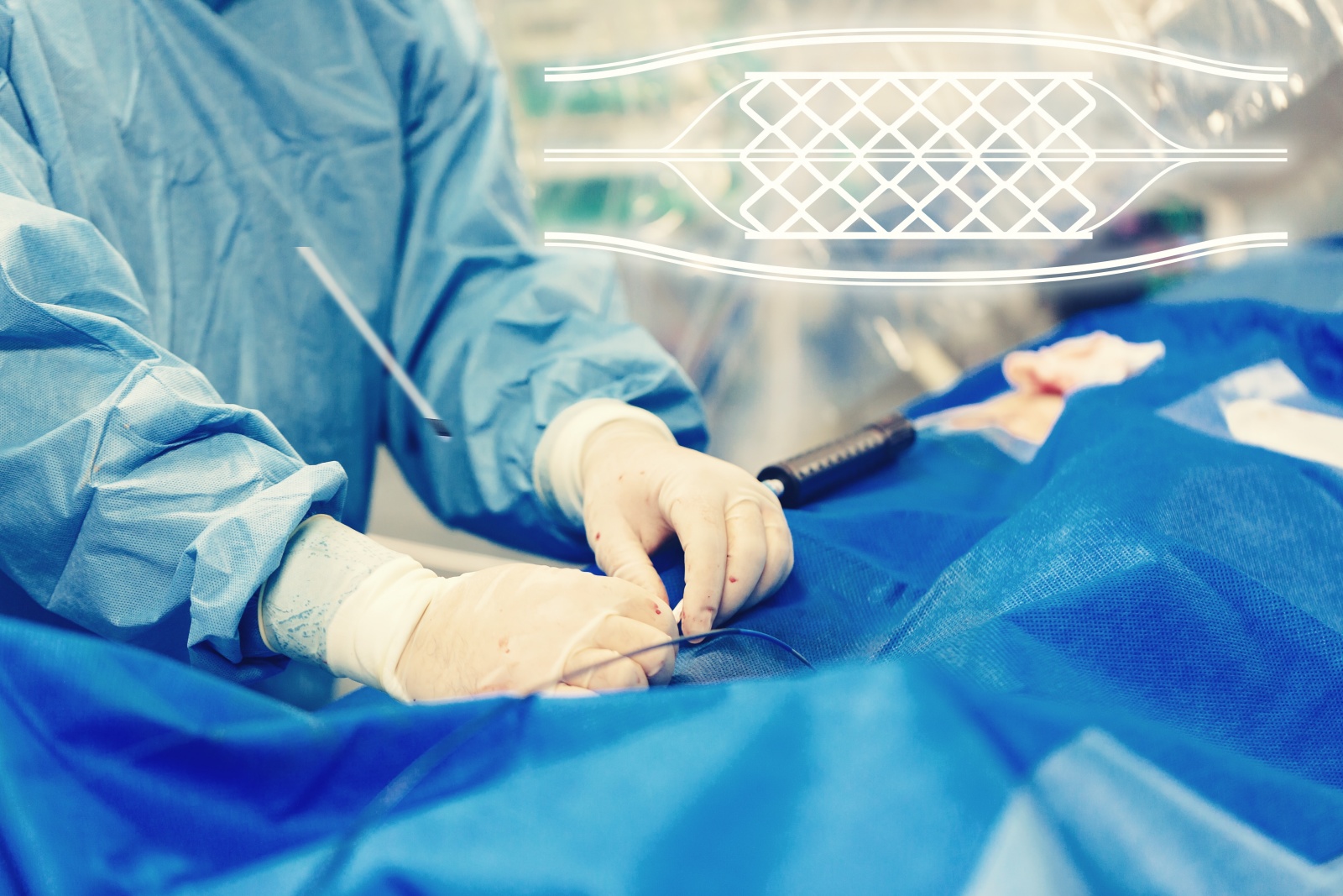 understanding-coronary-stents