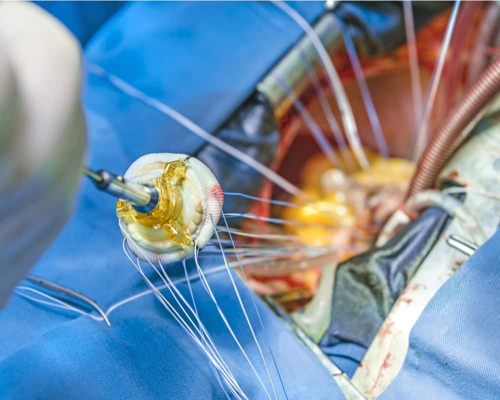 cardiac-valve-replacement-surgery