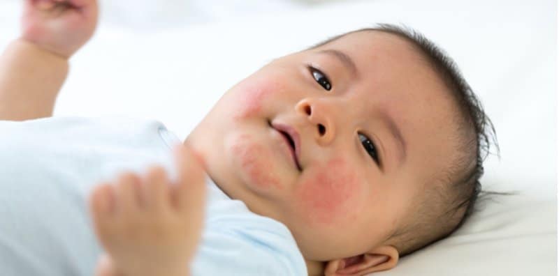 ways-to-prevent-allergies-in-babies