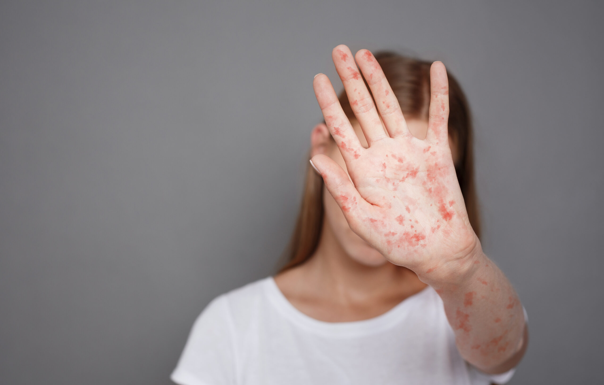 understanding-measles-virus-diseases