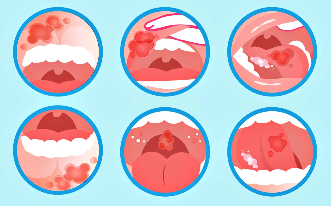 口腔红白斑是什么？症状、成因与治疗方法