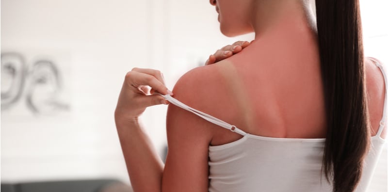 how-to-treat-and-care-for-sunburn