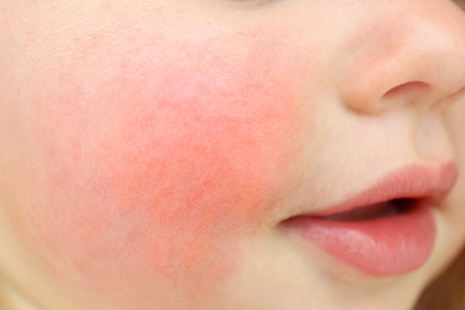 understanding-slapped-cheek-syndrome