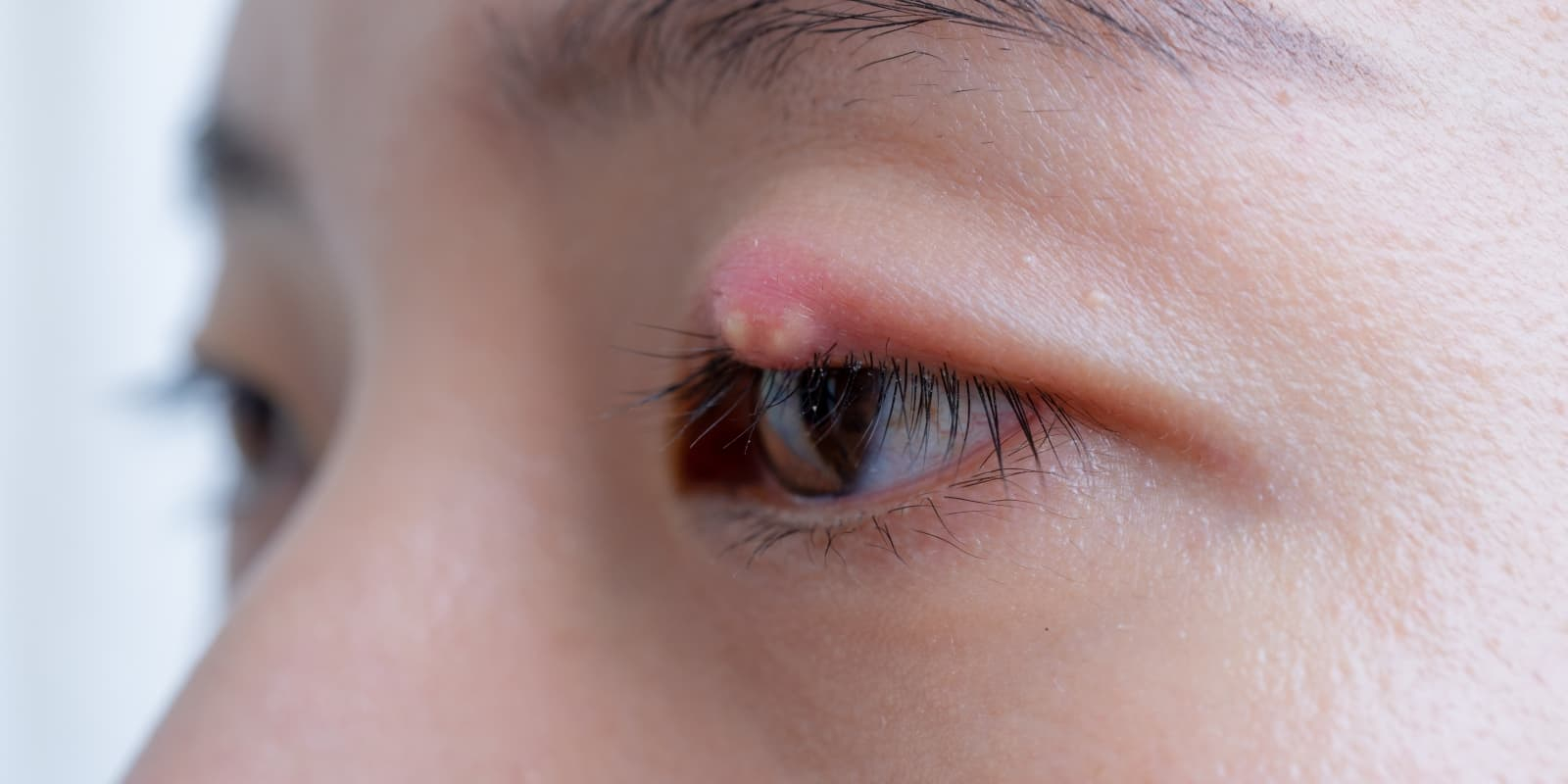 what-causes-a-stye-and-how-to-treat-it