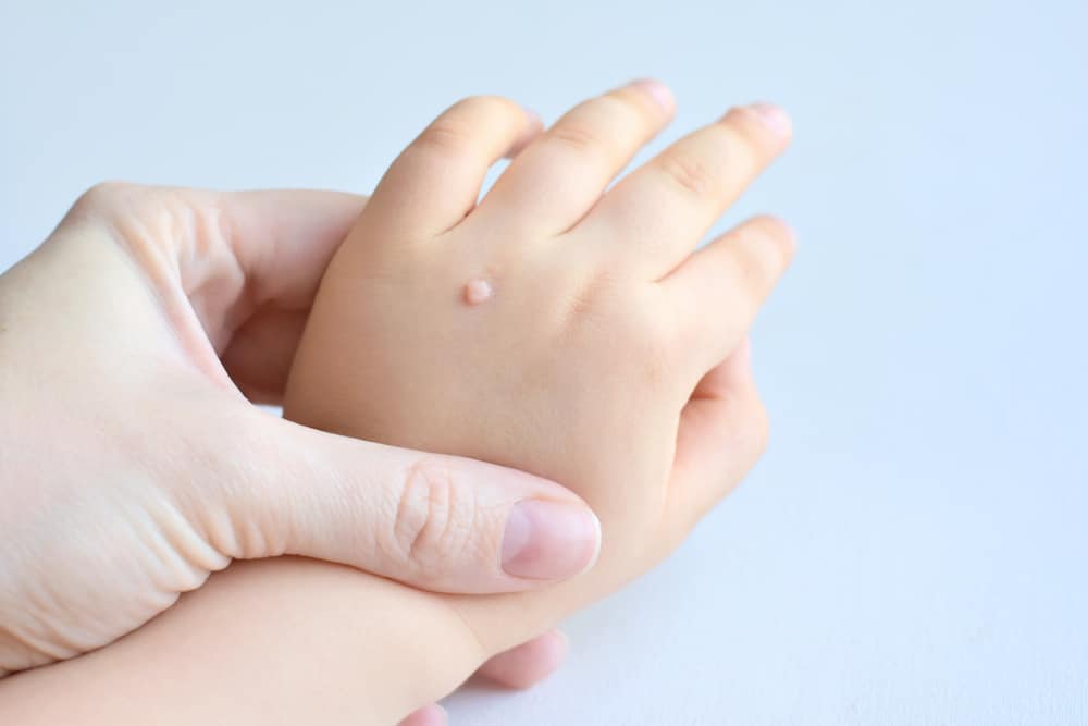 causes-symptoms-and-treat-of-mentverruca-vulgaris