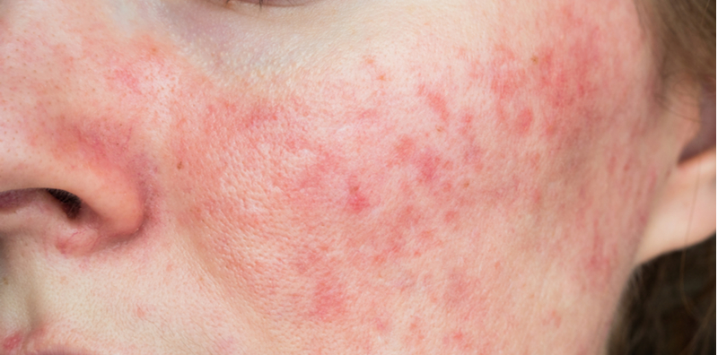 what-is-rosacea-and-why-does-my-face-turn-red