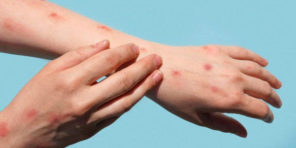 什么是猴痘（Mpox）？症状、传染途径与治疗一文看懂