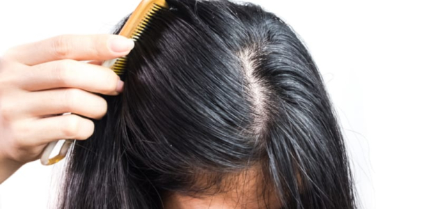 understanding-seborrheic-dermatitis