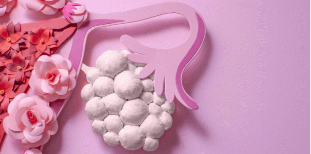 how-pcos-is-diagnosed-and-treated