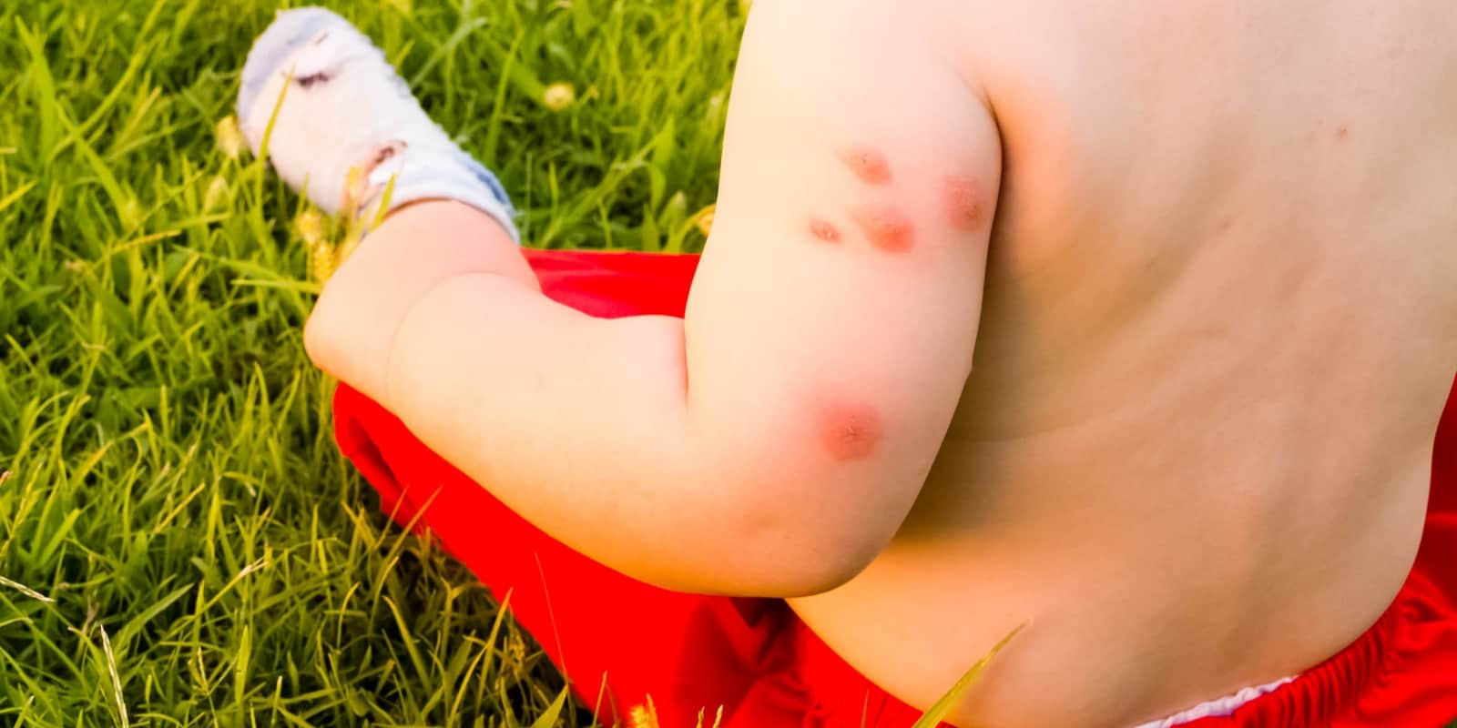 bites-from-mosquitoes-on-babies