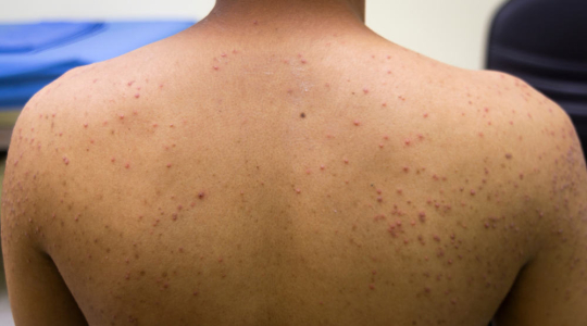 what-is-folliculitis