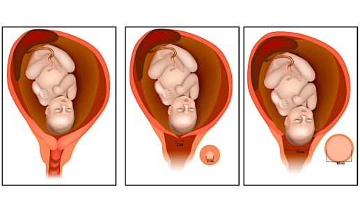crowning-and-the-stages-of-childbirth