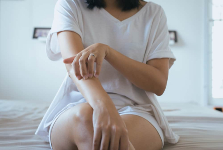 psoriasis-vulgaris