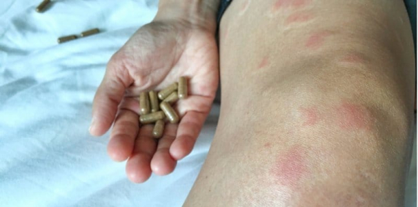 红斑性狼疮能治好吗？初期症状、影响寿命、成因与饮食注意事项一次了解