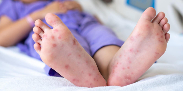 肠病毒症状详解：成人儿童初期症状、多久痊愈、传染潜伏期