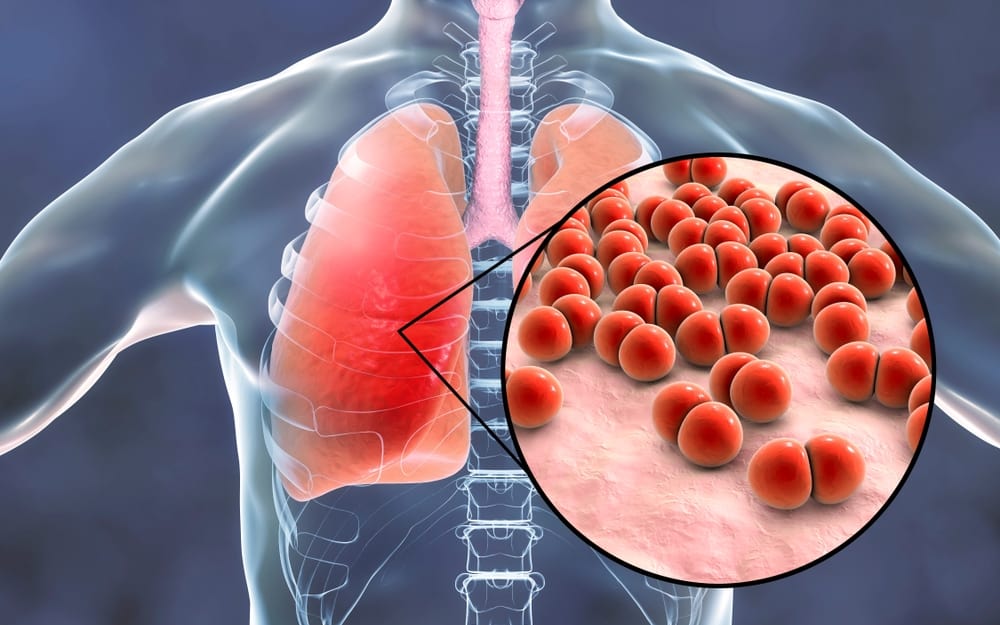 understanding-pneumonia
