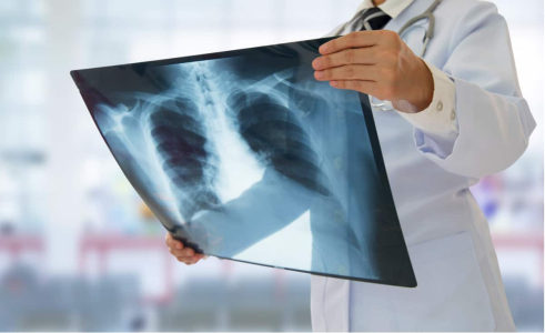 understanding-tuberculosis