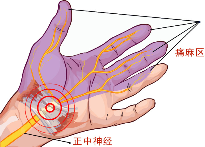 腕隧道症候群该看哪一科？症状、原因、治疗与检查