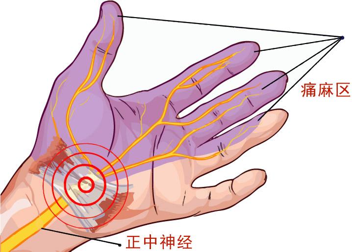 clear-breakdown-of-carpal-tunnel-syndrome