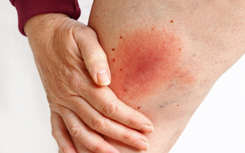 understanding-lyme-disease