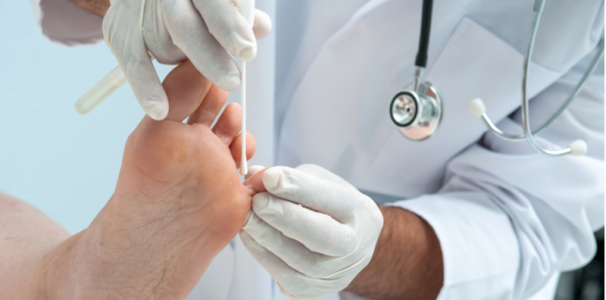 treatment-for-athletes-foot